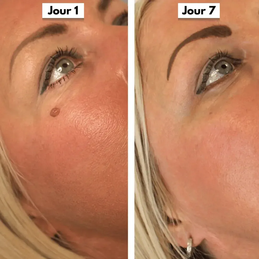 DermaCore | Anti-Excroissances de Peau