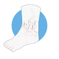 Neuropathie diabétique
