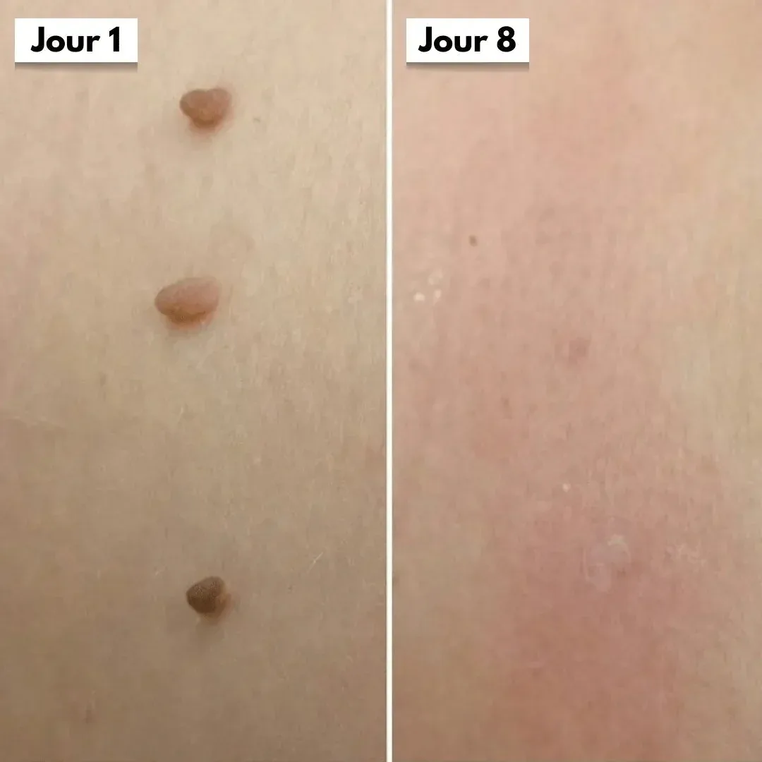 DermaCore | Anti-Excroissances de Peau