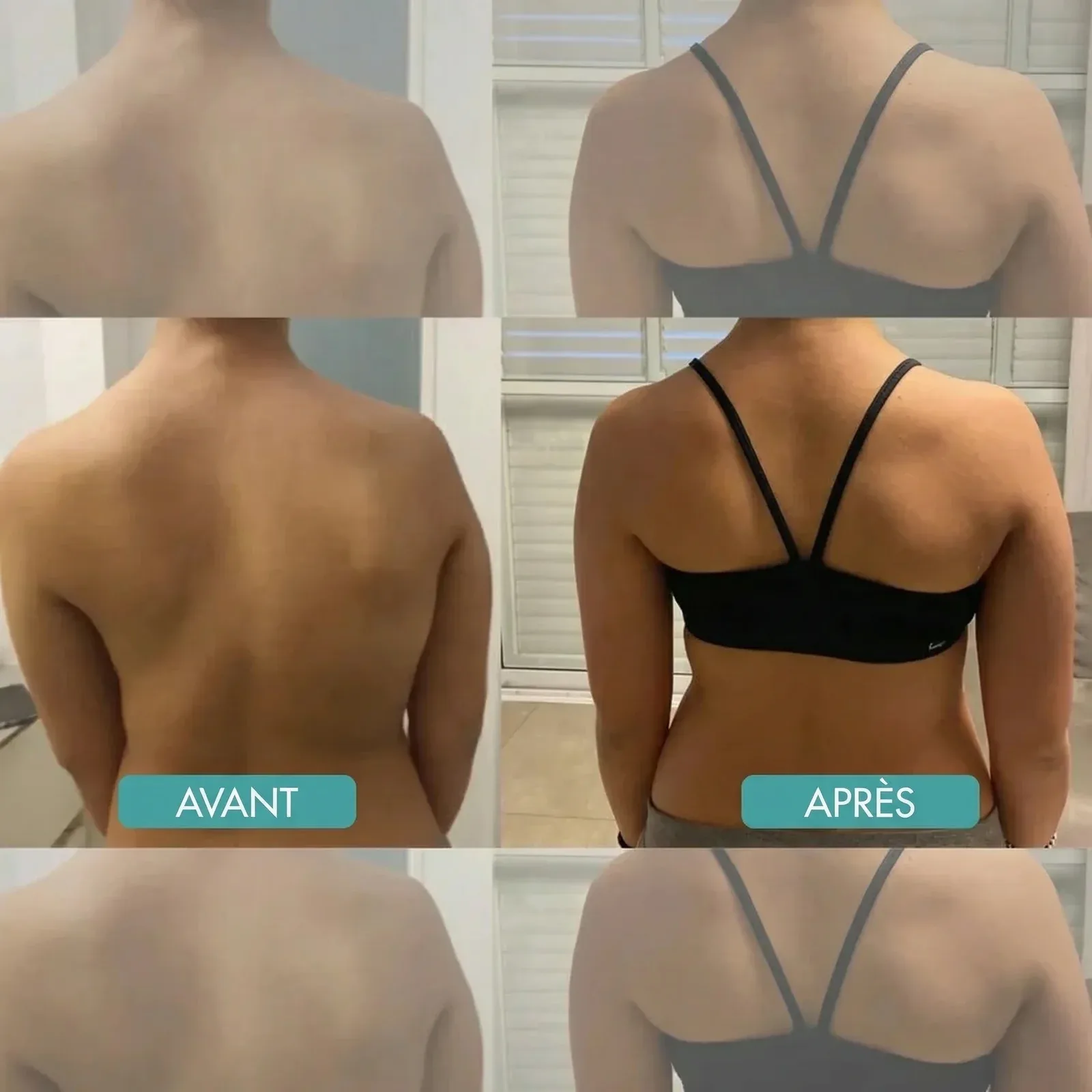 BackAlign | Correcteur de posture instantané
